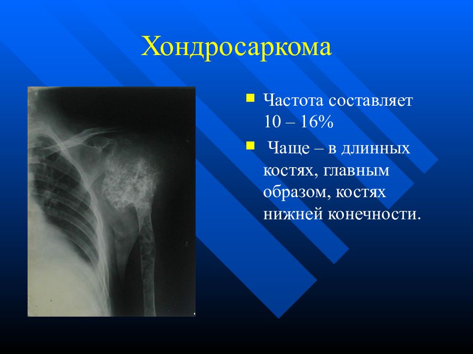 Рак костей анализы