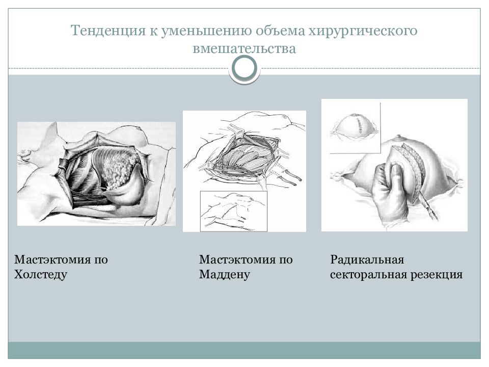 Радикальная мастэктомия