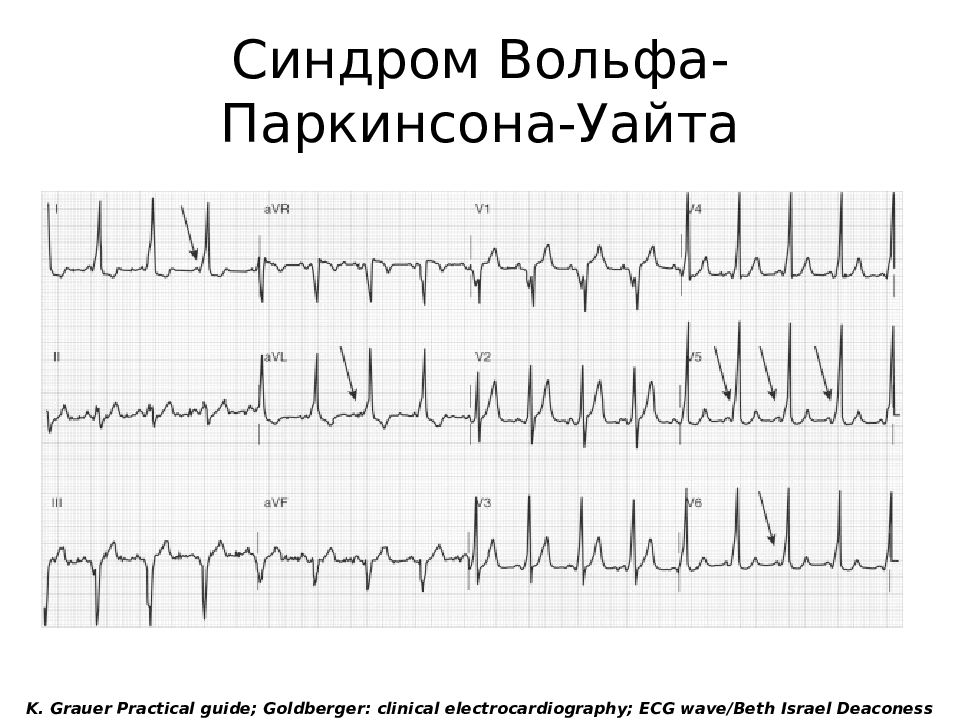 Экг при тиреотоксикозе картинки