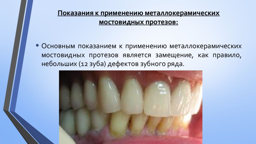 Металлокерамические мостовидные протезы презентация