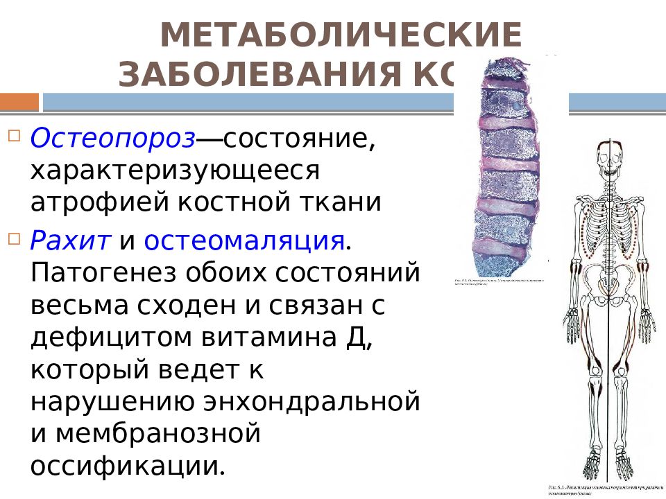 Костная болезнь. Остеомаляция остеопороз костной ткани. Метаболические заболевания костей. Элементы костной системы. Механизм развития остеопороза и остеомаляции.