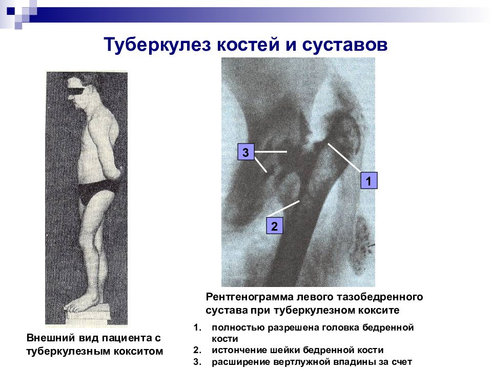 Туберкулез костей. Туберкулезное поражение костей схема. Туберкулез костей и суставов у детей клинические. Туберкулёз костей симптомы. Туберкулез трубчатых костей.