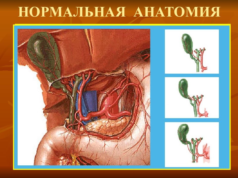 Острый холецистит картинки