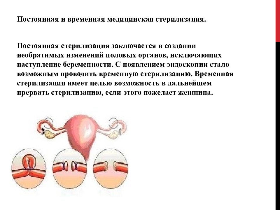 Временный медицинский. Женская стерилизация презентация. Медицинская стерилизация право. Медицинская стерилизация женщин презентация.