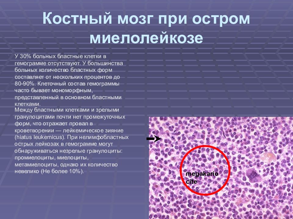 Анализ клетки костного мозга. Хронический миелобластный лейкоз гистология. Острый миелобластный лейкоз гистология. Хронический миелобластный лейкоз костный мозг гистология. Острый миелобластный лейкоз патанатомия.