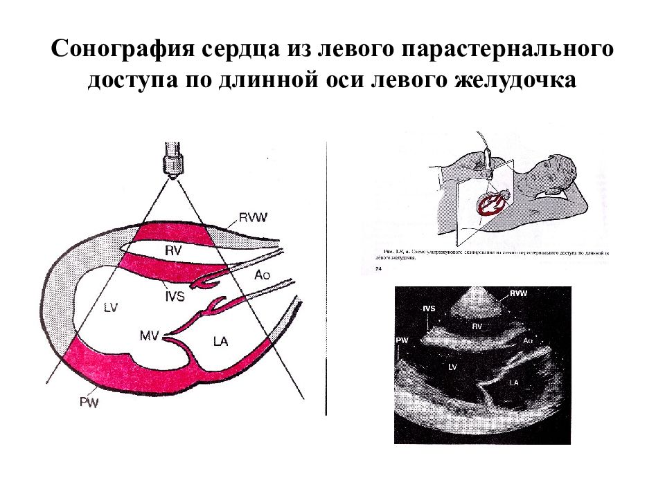 Эхо левого желудочка