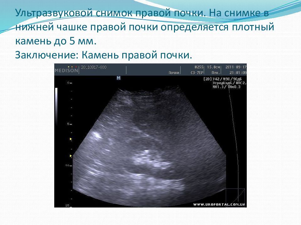 Узи почек и мочевого пермь. Конкременты в почках на УЗИ что это такое. Ультразвуковое исследование почек конкременты. Камни в почках на УЗИ.