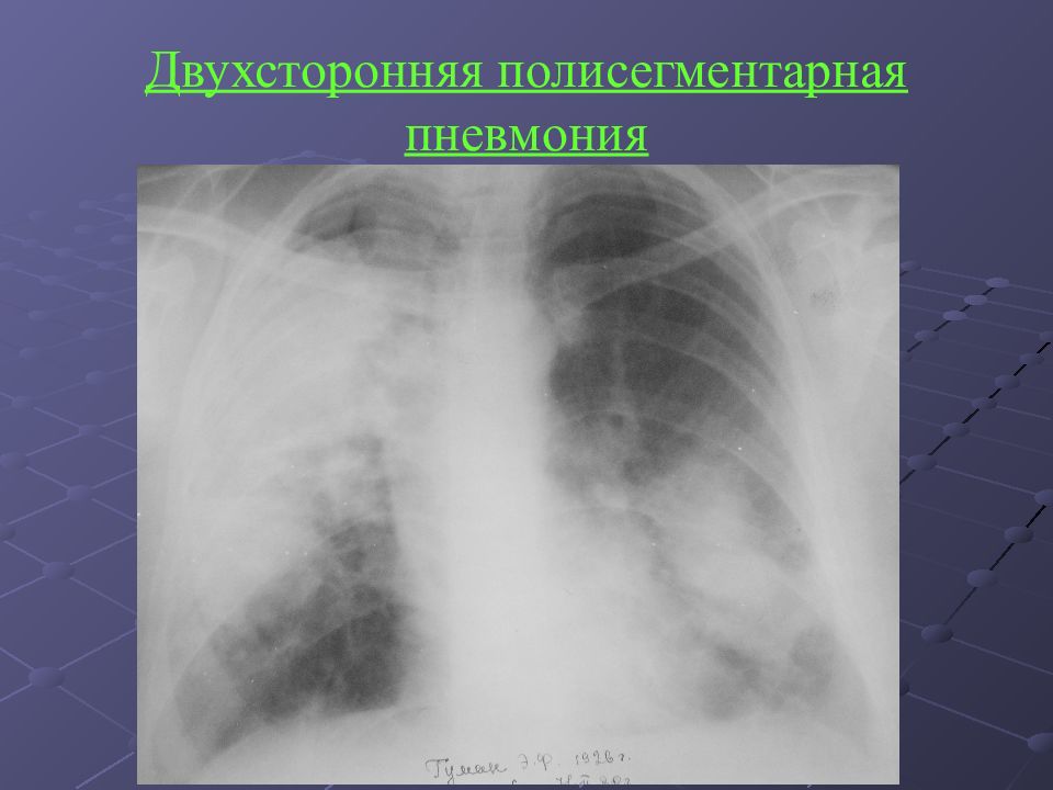 Вирусная пневмония видна на рентгене. Двусторонняя полисегментарная инфильтрация. Полисегментарная пневмония кт3. Двухсторонняя полисегментарная пневмония кт1. Левосторонняя полисегментарная пневмония рентген.