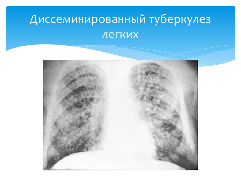 Лучевая диагностика органов дыхания презентация