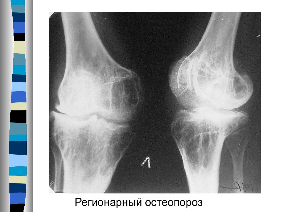 Очаг костей. Остеопороз кости рентген. Остеопороз коленного сустава рентген. Регионарный остеопороз костей сустава. Ревматоидный артрит коленного сустава рентген.