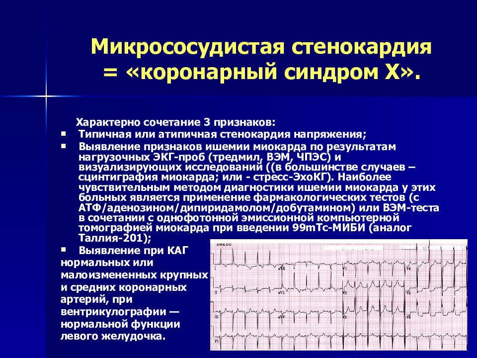 Экг синдромы. ЭКГ при микроваскулярной стенокардии. Диагностические критерии микрососудистой стенокардии. ЭКГ признаки микроваскулярной стенокардии. ЭКГ при микрососудистой стенокардии.