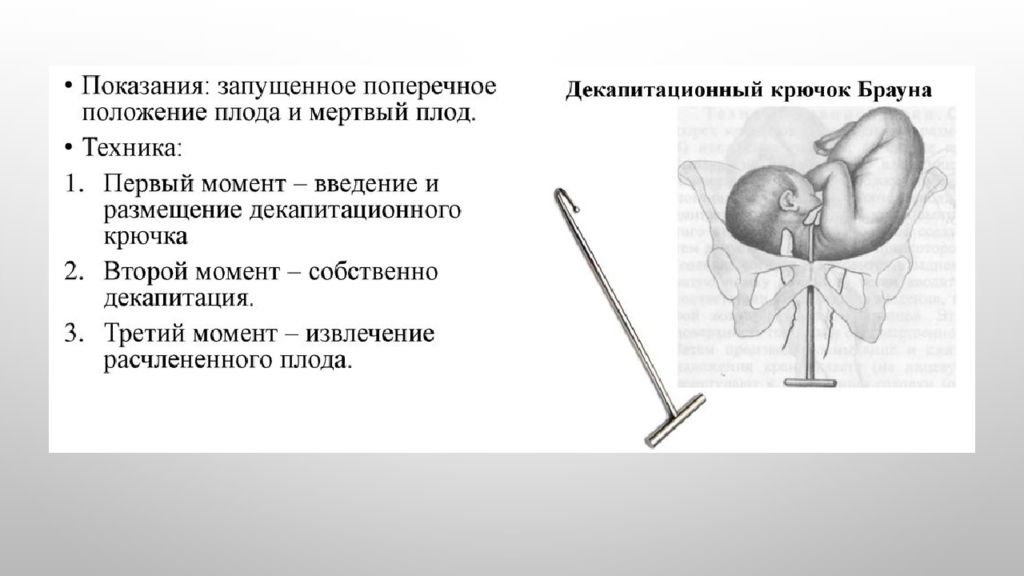 Плодоразрушающие операции презентация