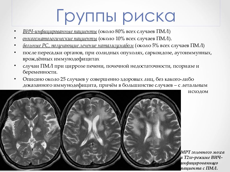 Лейкоареоз головного