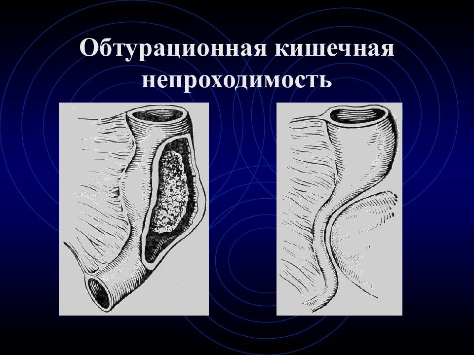 Кишечная непроходимость клиническая картина