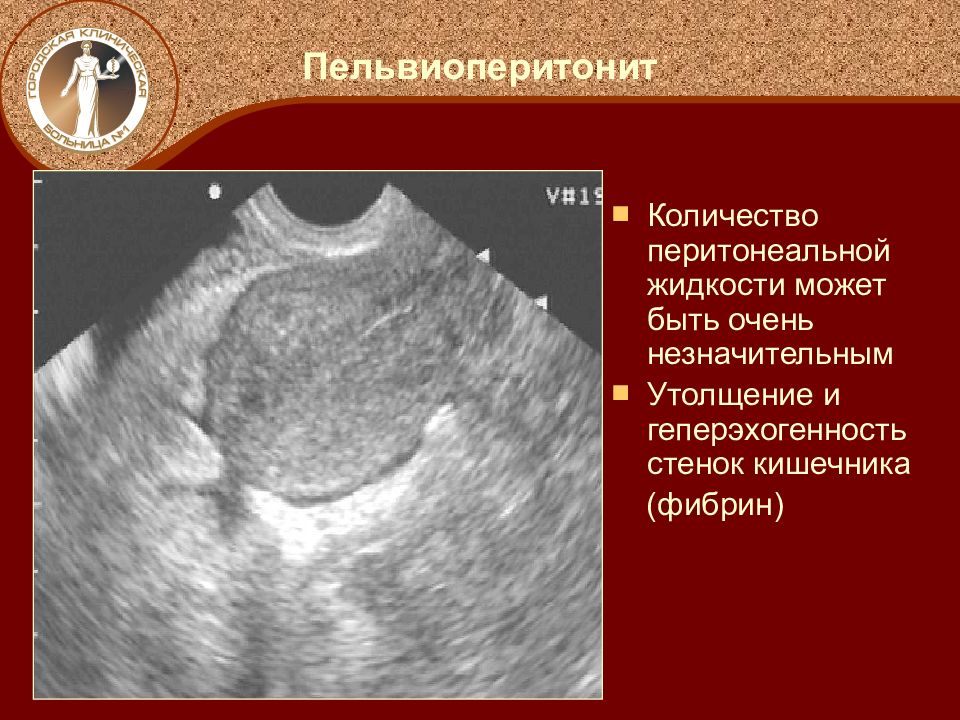 Гинекологический перитонит. Послеродовый пельвиоперитонит. Пельвиоперитонит и перитонит. Пельвиоперитонит симптомы.