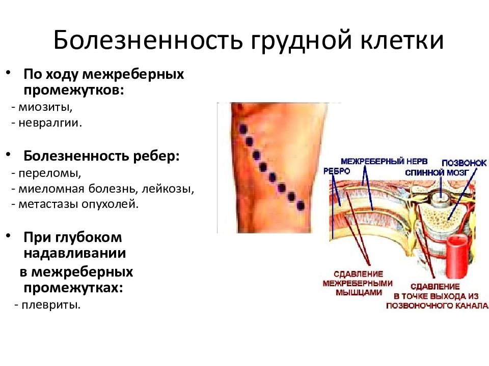 Межреберная невралгия карта вызова