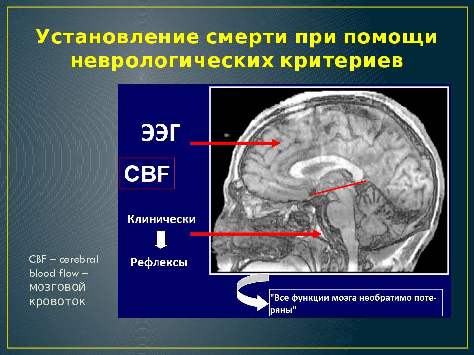 Умерший мозг. Смерть головного мозга понятие. Смерть мозга неврология.