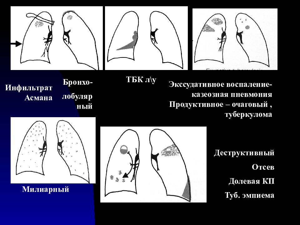 Казеозная пневмония схема