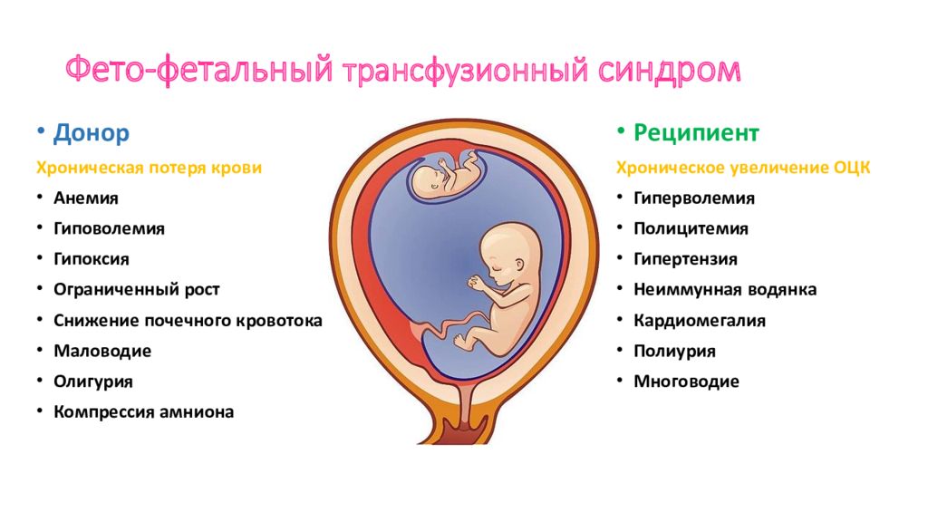 Синдром донора. Фето-фетальный трансфузионный синдром УЗИ. Монохориальная многоплодная беременность. Двойня фето фетальный синдром монохориальная диамниотическая. Синдром фето-фетальной трансфузии при многоплодной беременности.