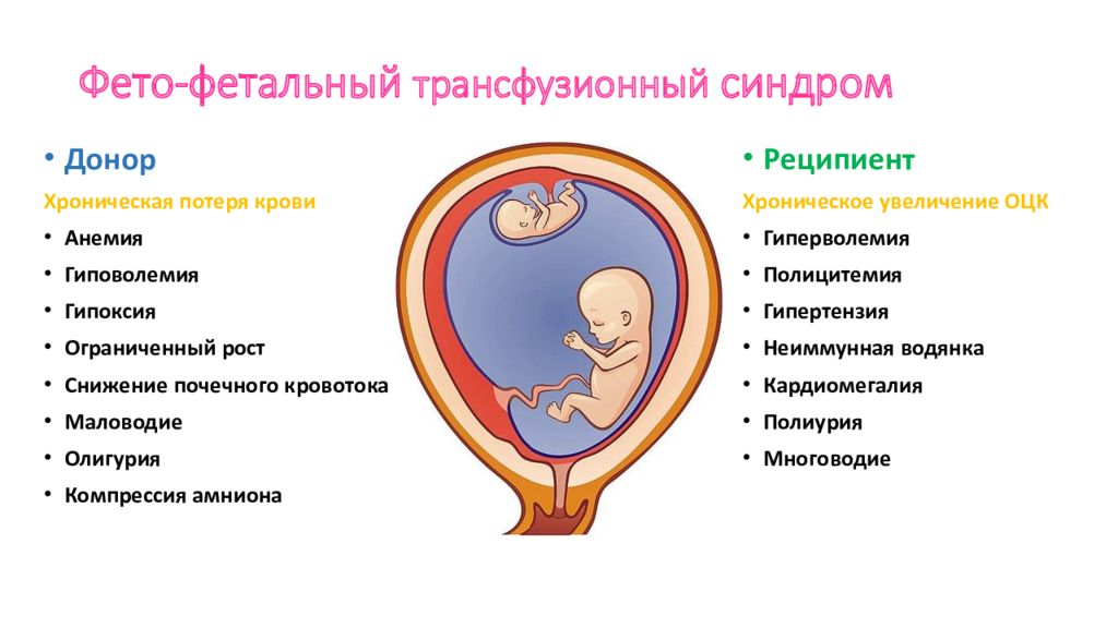 Фето фетальный трансфузионный синдром. Фето-фетальный трансфузионный синдром УЗИ. Монохориальная двойня фето фетальный синдром. Фето фетальный синдром у близнецов. Фитофитальный синдром.