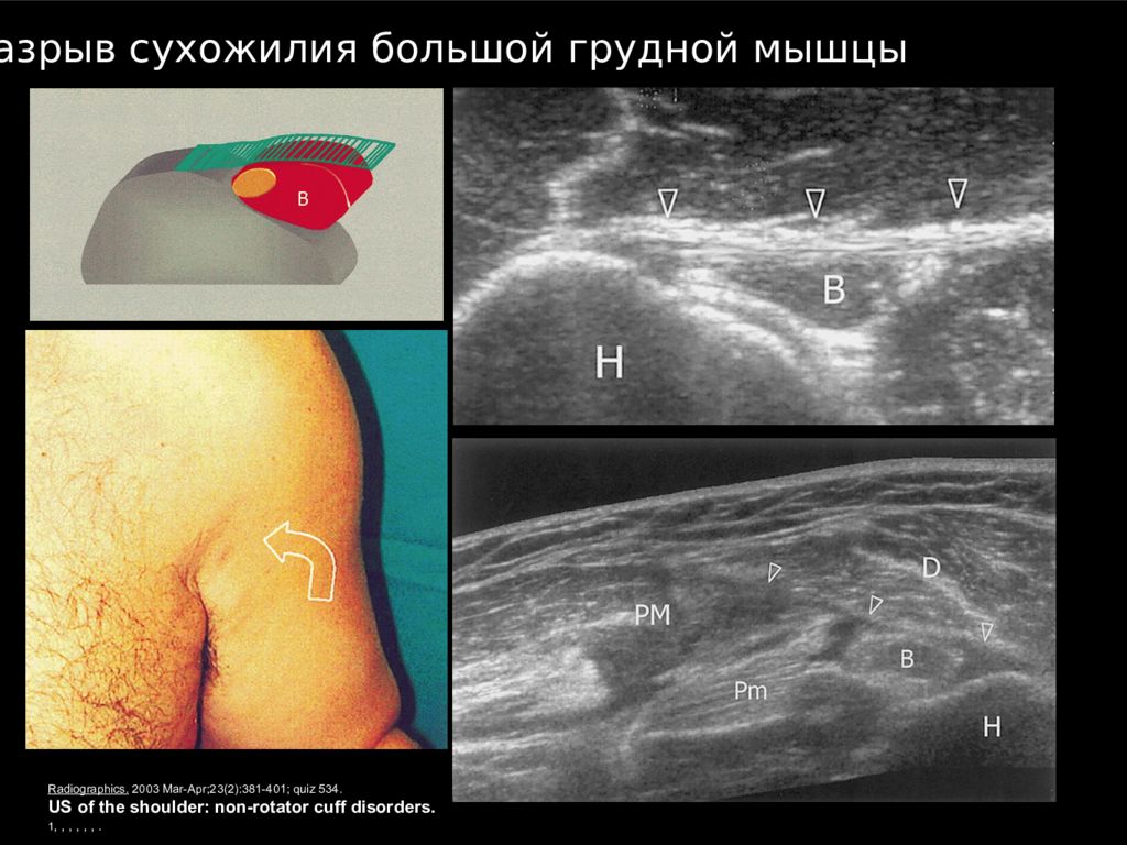 Узи мышц. Надрыв сухожилия плечевого сустава УЗИ.