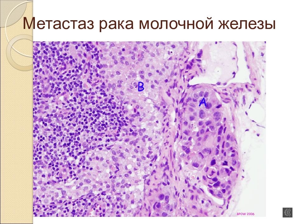 Метастазы Молочной Железы Фото