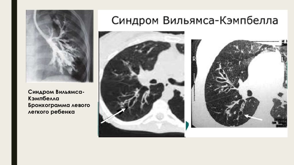 Пороки Развития Трахеи