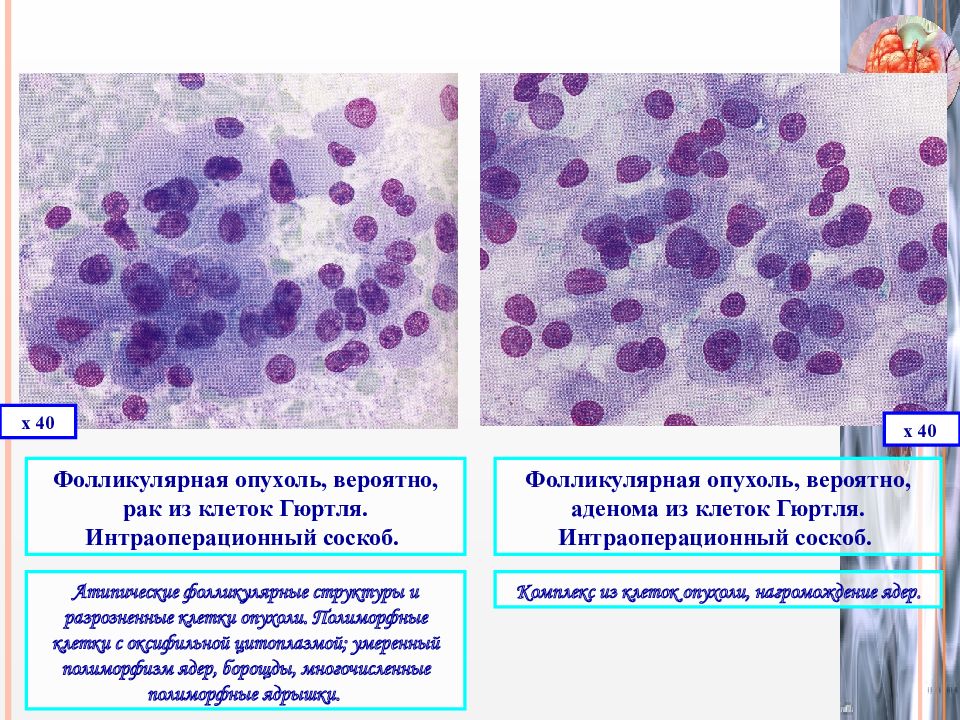 Цитологическая картина фолликулярной в клеточной опухоли щитовидной железы bethesda iv