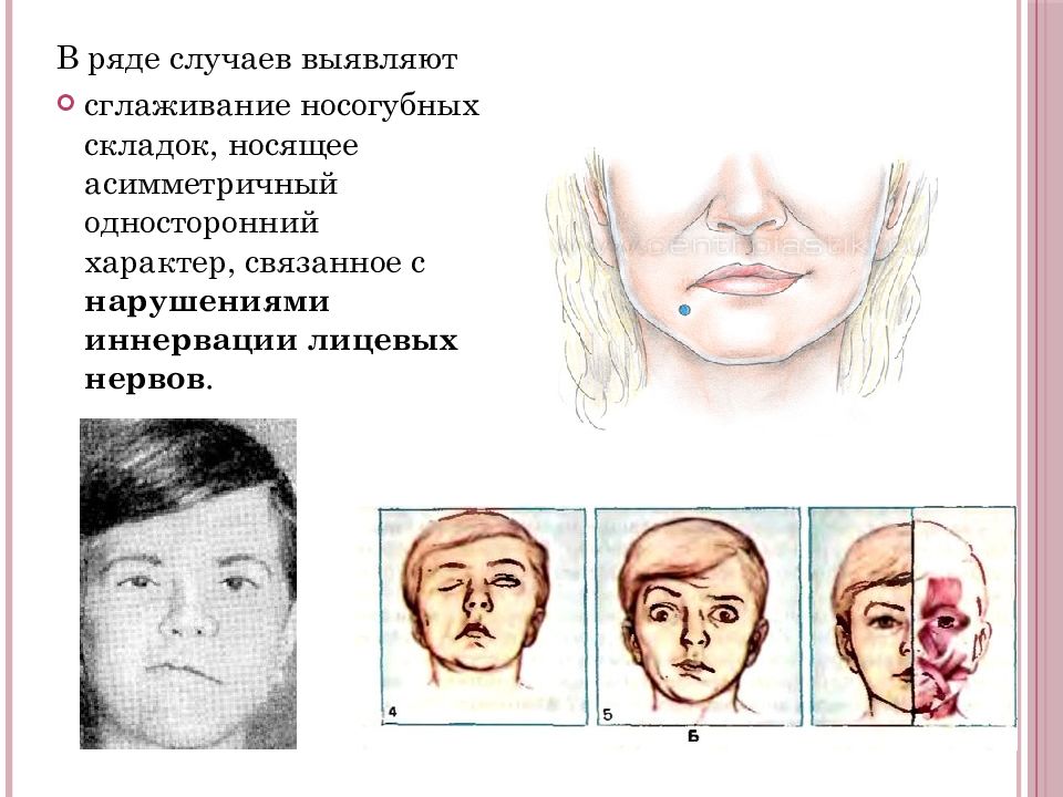 Дизартрия после инсульта. Сглаженность носогубной складки. Сглаженность носогубной складки у детей. Сглаженность носогубной складки при дизартрии. Сглаженность правой носогубной складки.
