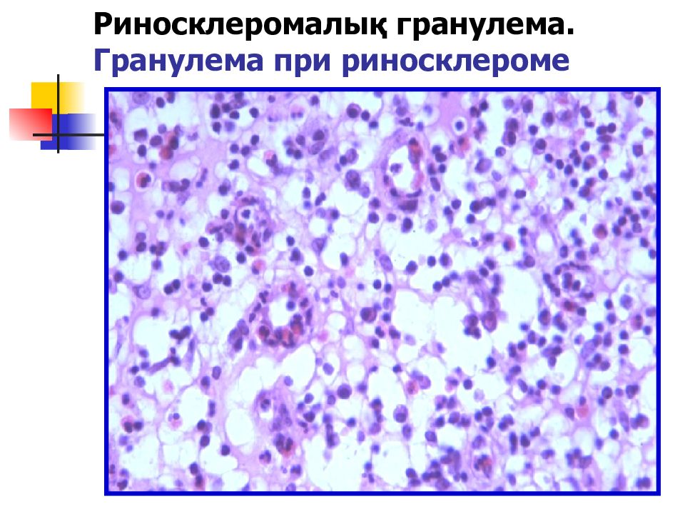 Риносклерома гистология. Риносклерома патанатомия. Риносклерома гранулема. Риносклерома. Лепрозная гранулема строение.