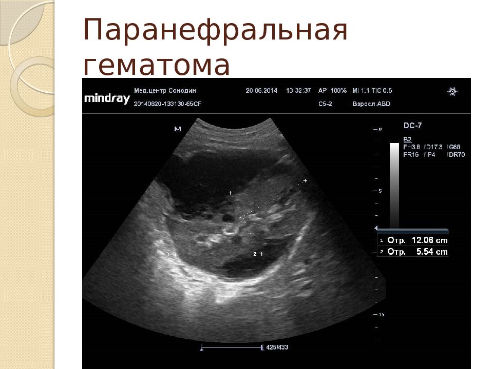 Узи почек на голодный. УЗИ. УЗИ почек. Почка при УЗИ. УЗИ почек снимок.