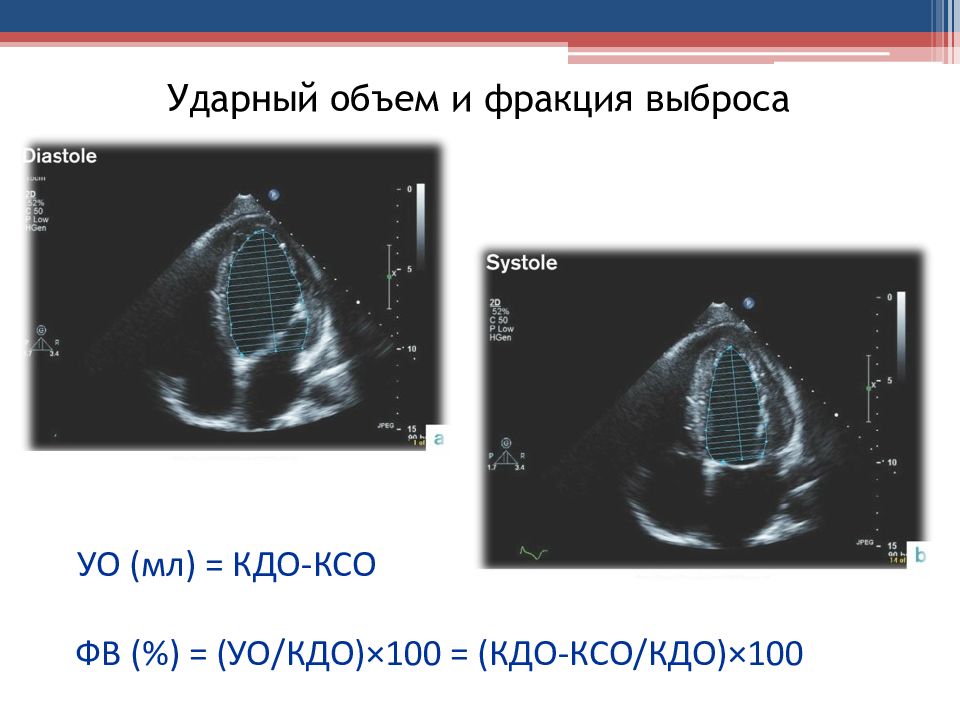 Фракция выброса и ударный объем. Конечный диастолический объем. КДО И КСО левого желудочка. Конечно-диастолический объем больше ударного объема.