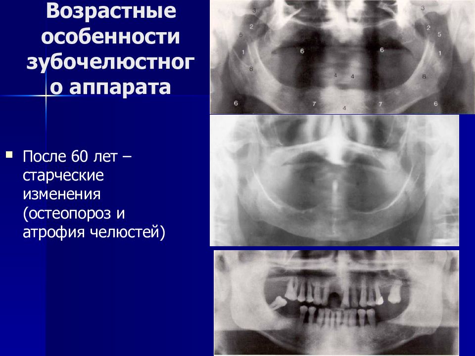 Остеопороз челюсти фото