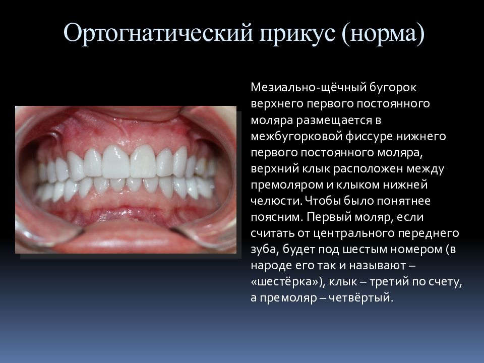 Опистогнатический прикус картинки