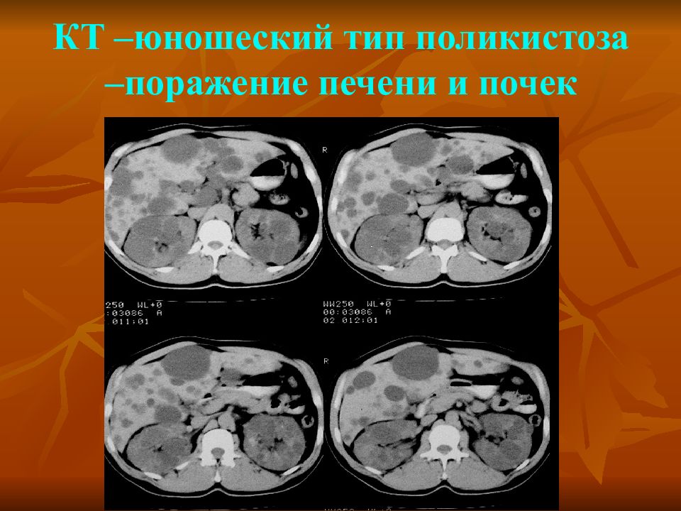 Кт почек презентация