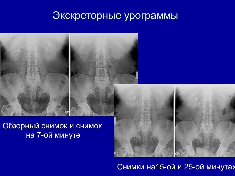 Обзорный снимок. Экскреторная урограмма на 7 минуте. Экскреторные урограммы. Обзорная урограмма. Экскреторная урограмма на 5 минуте.