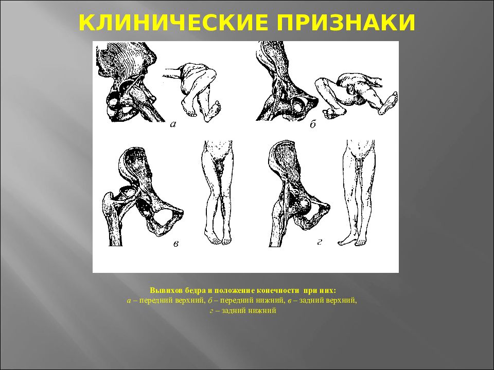 Вывих признаки. Клинические проявления вывиха. Клинические признаки вывиха. Клиническая картина вывиха. Клинический признак вывиха бедра.