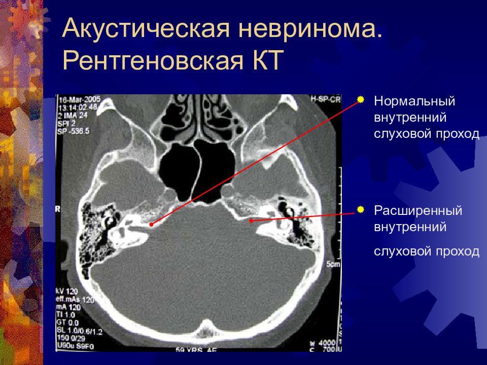 Внутреннее расширение. Анатомия слухового прохода на кт. Расширение внутреннего слухового прохода кт. Внутренний слуховой проход на кт. Акустическая невринома.