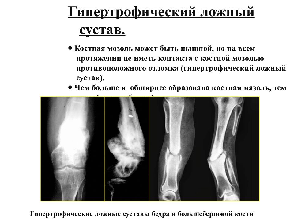 Ложный сустав презентация