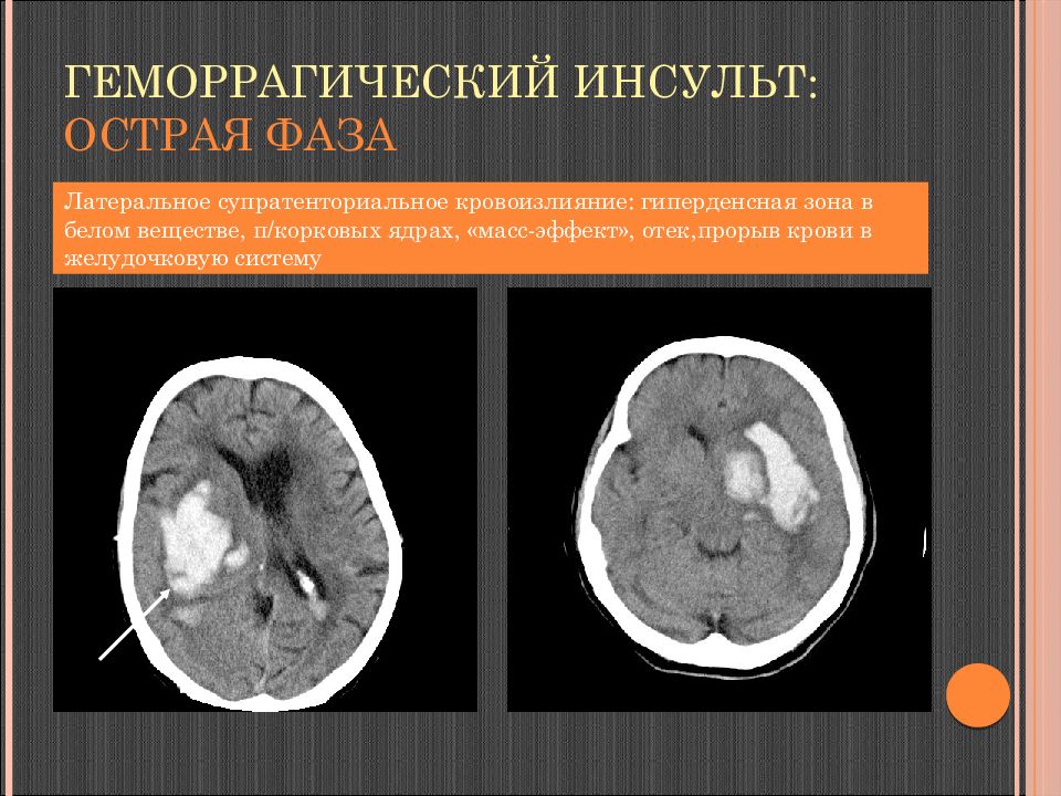 Зона инсульта. Геморрагический инсульт головного мозга кт. Кт при геморрагическом инсульте. Ишемический и геморрагический инсульт на кт. Ишемический инсульт кт.