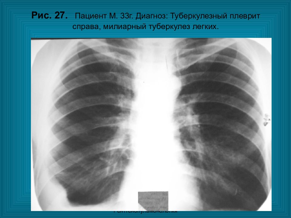 Половина легких. Туберкулезный плеврит рентген. Милиарный туберкулез рентген. Милиарный карциноз легких. Милиарный карциноматоз легких.