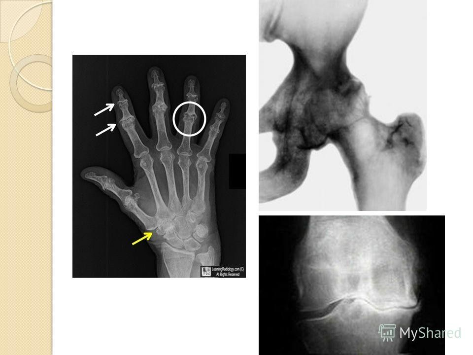 Склероз суставных поверхностей. Остеосклероз кисти рентген. Склероз суставных поверхностей кистей. Узурация суставных поверхностей рентген.