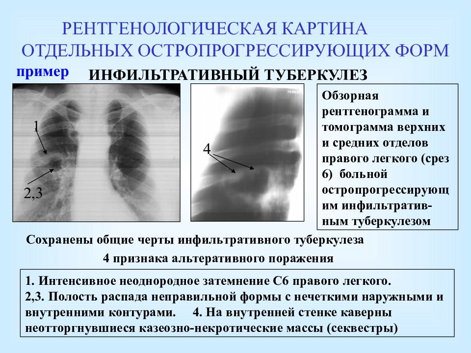 Очаговый и инфильтративный туберкулез презентация