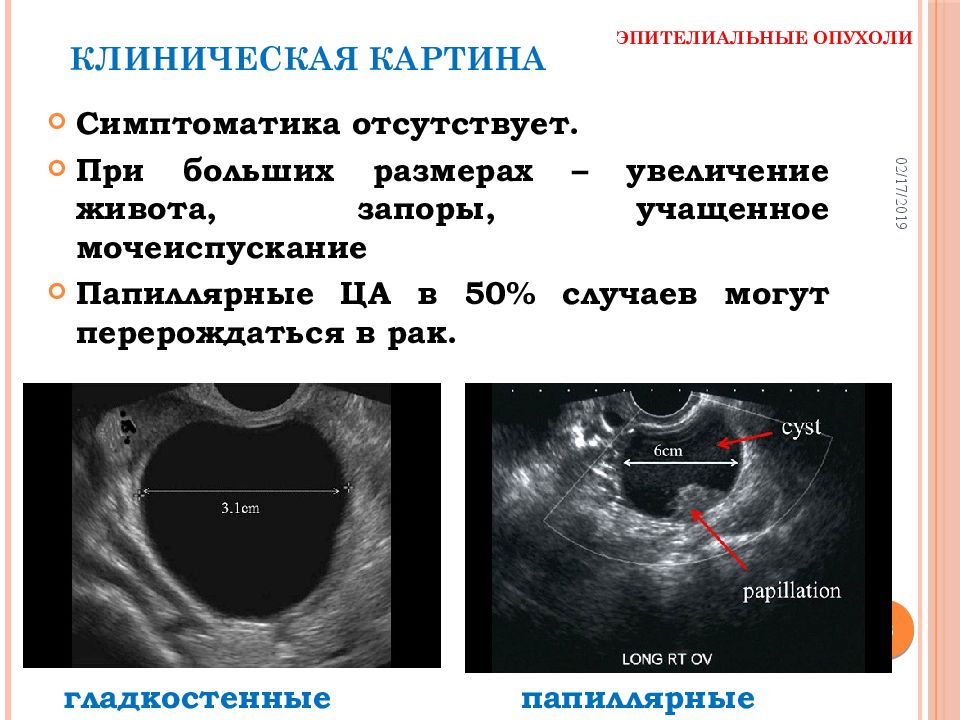 Клиническая картина рака яичников