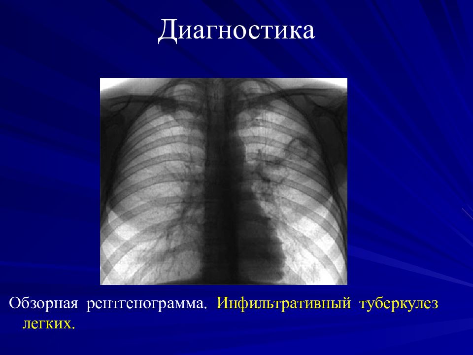 Инфильтративный туберкулез легких презентация