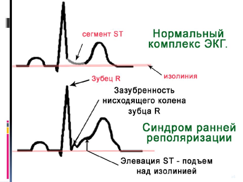 Реполяризация стенки. ЭКГ при синдроме ранней реполяризации. Синдром ранней реполяризации желудочков. Синдром ранней реполяризации ЭКГ критерии. ЭКГ ранняя реполяризация миокарда.