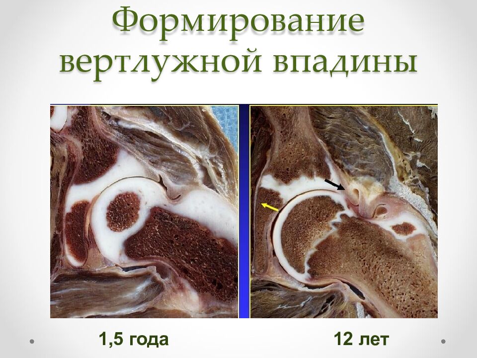 Формирование вертлужной впадины