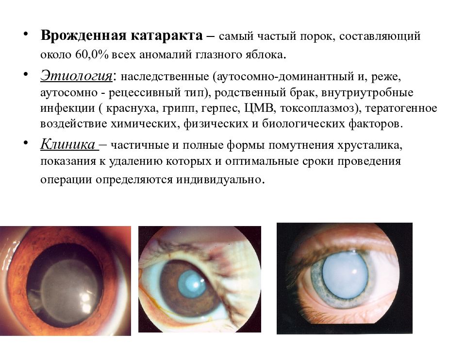Наследственные заболевания зрения. Веретенообразная врожденная катаракта. Врожденная зонулярная катаракта. Тип наследования врожденной катаракты.