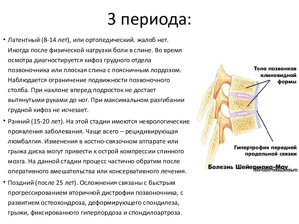 Болезнь шейермана. Болезнь Шейермана-МАУ классификация. Шейермана МАУ классификация. Операция при болезни Шейермана МАУ.