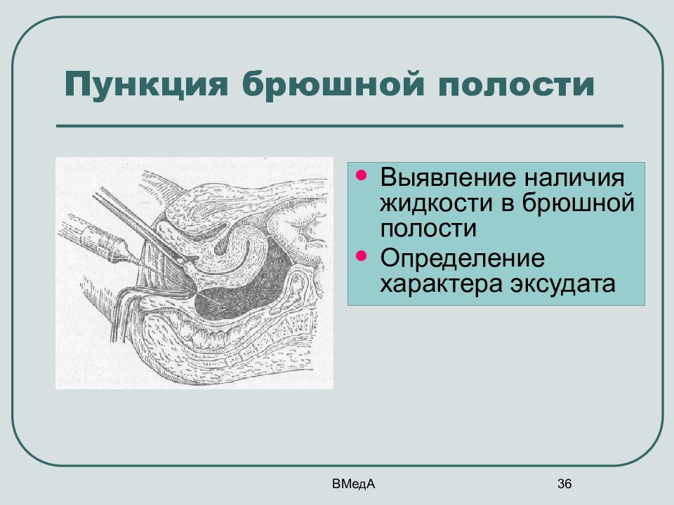 Абдоминальная пункция картинки